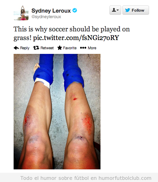 Tweet con fotos de pierna destrozada de la jugadora de fútbol Sidney Leroux