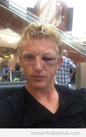 Foto de las lesiones en la cara de Dirk Kuyt