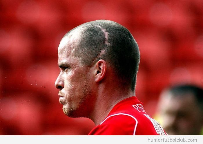 Jugador de fútbol con una cicatriz muy grande en la cabeza