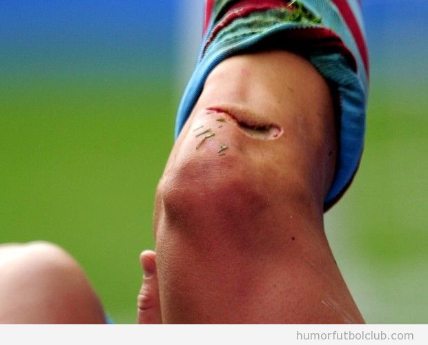 Lesión y herida en la rodilla de Joe Bennet, futbolista del Ashton Villa
