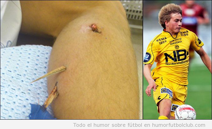 Foto dolorosa de un jugador de futbol sala en Noruega con astillas clavadas en la pierna