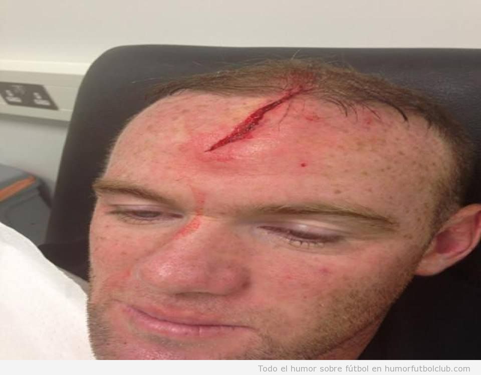 Foto de la herida en la cabeza de Rooney